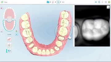 How to use the iTero™ Snapshot tool and Scan Report | iTero intraoral scanner training