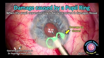 CataractCoach™ 2272: beschadigd door een pupilverwijdingsring