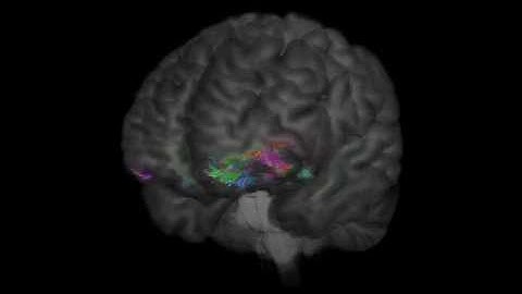 Inferior Fronto-Occipital Fasciculus