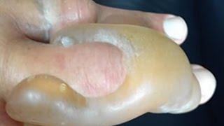 Hulk Hogan's Worst Injury
