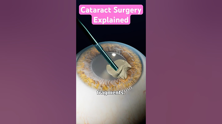 Cataract Surgery Explained 👁️