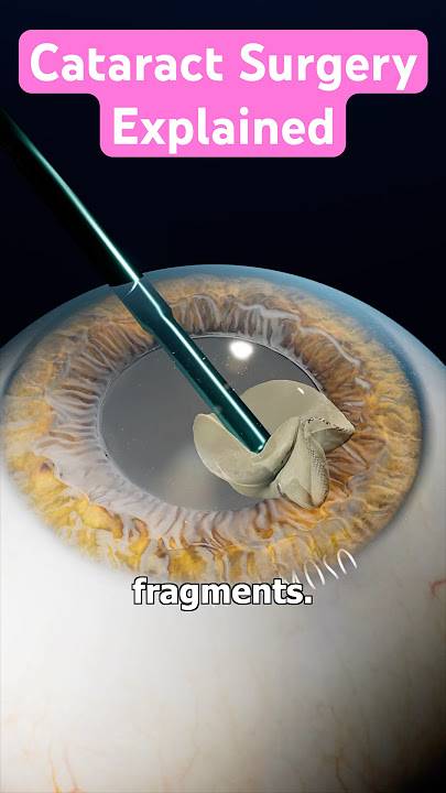 Cataract Surgery Explained 👁️