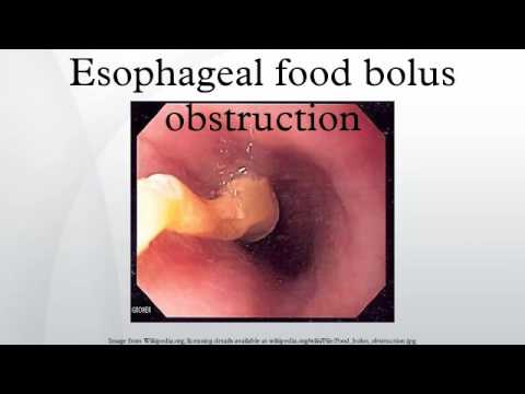 Esophageal food bolus obstruction - YouTube