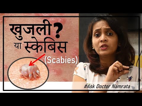 ये खुजली क्या स्केबिस ( Scabies ) है ? क्यों हुआ ? इलाज कैसे करे ? #AskDoctorNamrata