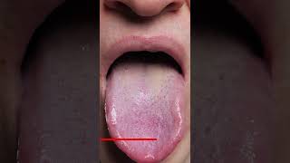 Tongue Exercises Post-Surgery  | Tongue Exercises | shorts