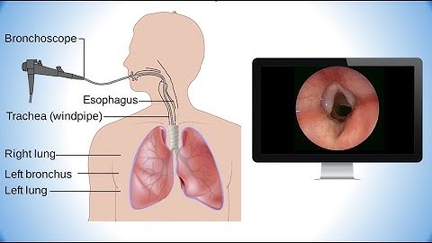 Bronchoscopy CPT code - simplify medical coding