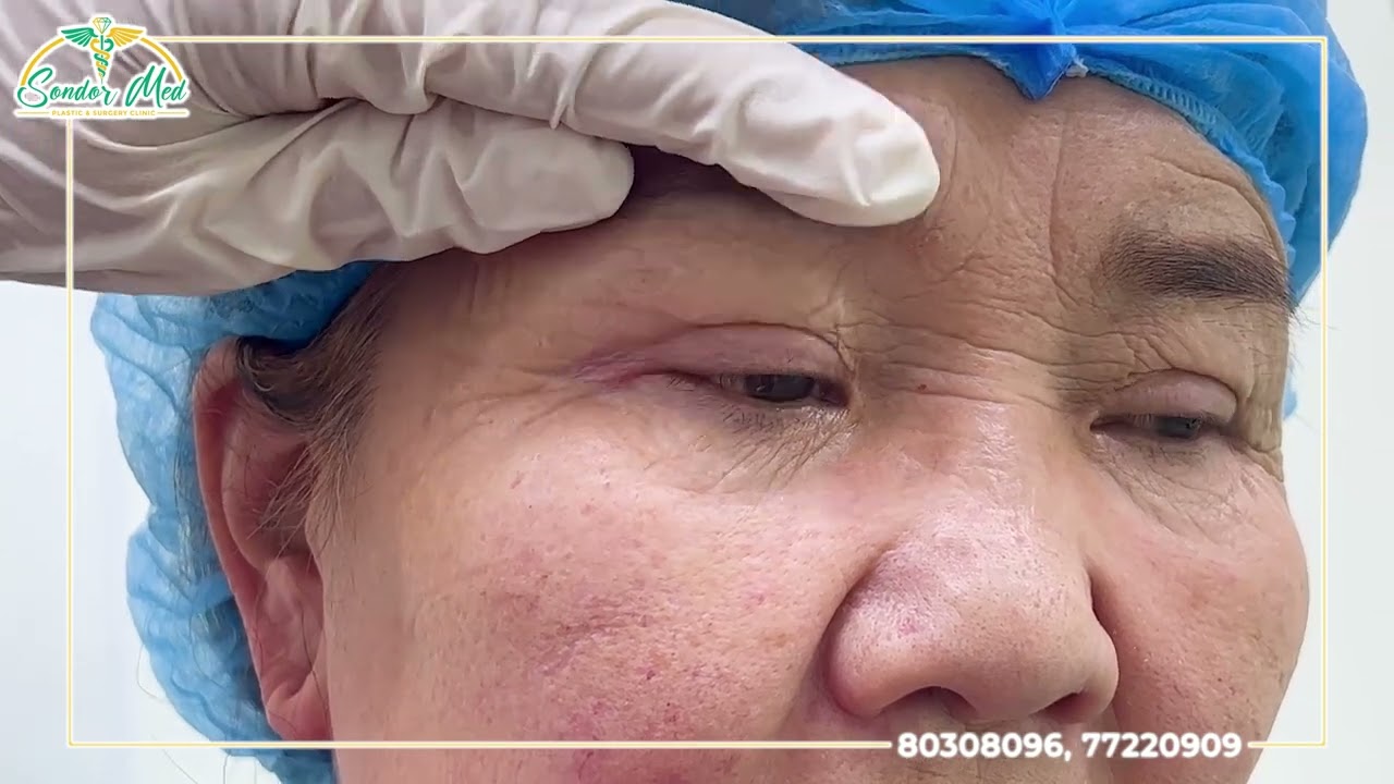 ✨ Хөмсгөн доогуурх зүсэлттэй зовхи татах мэс засал