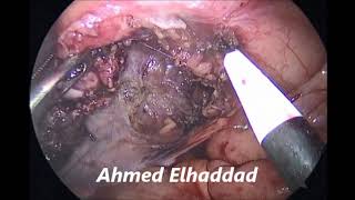 laparoscopic appendectomy difficult