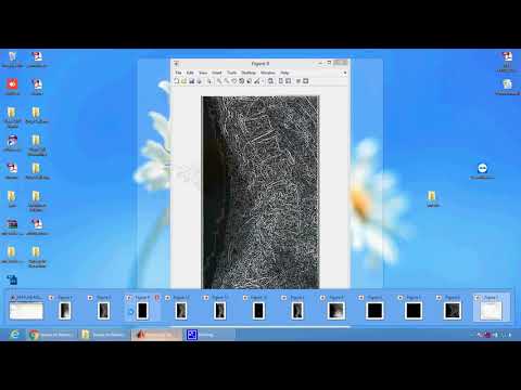 A Survey on Detection and Diagnosis of Osteoporosis in Matlab