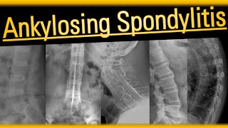 Ankylosing Spondylitis #arthritis #radiology #bones