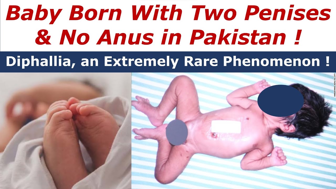What is 'Diphalia', the extreme rare medical condition which affect ...