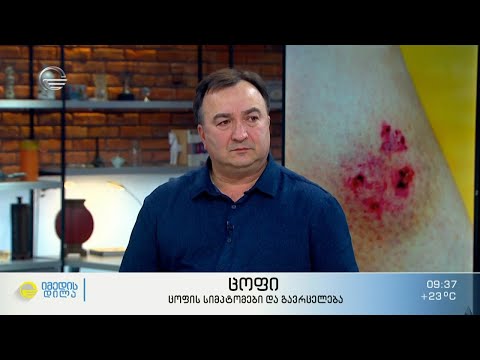 ცოფი - ინფექცია, რომელიც სიკვდილს იწვევს