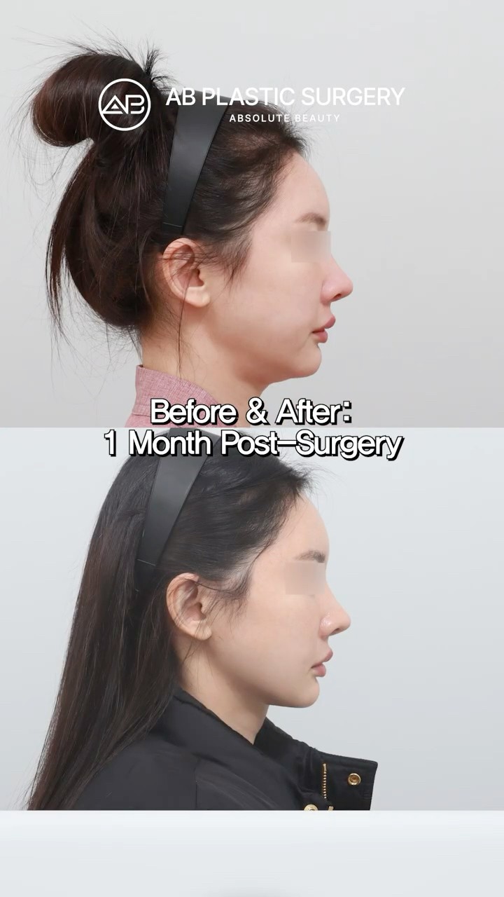 Jawline Transformation After Double Chin Surgery #shorts