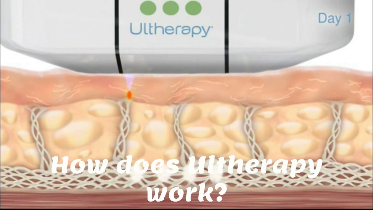 Ultherapy Laser Facelift Thailand YouTube