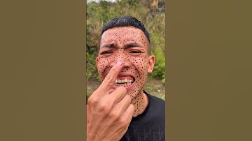 How I Cured a Bug Bite with Yogurt in the Wild Survival Hacks p4363