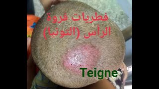 فطريات فروة الرأس #فطريات الشعر #Teigne du Cuir chevelu