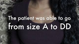 Breast Augmentation Patient Review | Dr. Hanna, la Nouvelle Medical Spa