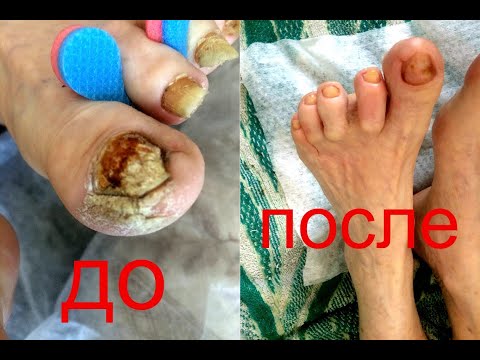 Грибок ногтей особенности обработки,лечения,профилактики Часть 1