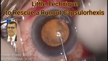 Little Technique to Rescue a Runout Capsulorhexis during phacoemulsification