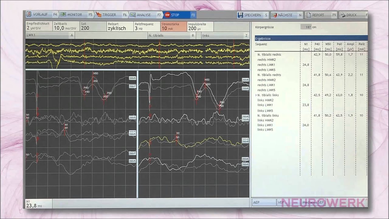Evoked Potentials - SEP Tibial Nerve - YouTube
