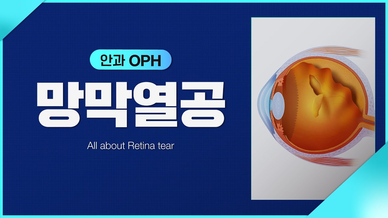 [인제안과] 망막 열공 어떤 증상이 있나요? 1