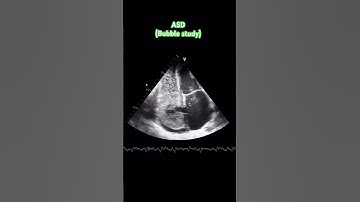 Atrial septal defect with bubble study 2D echo #cardiology #cardiacimaging #echocardiography