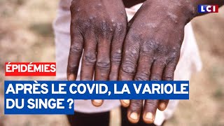 Variole du singe : faut-il avoir peur ?