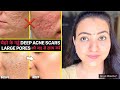 कितने भी पुराने गड्ढे LARGE PORES, DEEP ACNE SCARS हों चेहरे पर, इस Remedy से होगा 100% फायदा