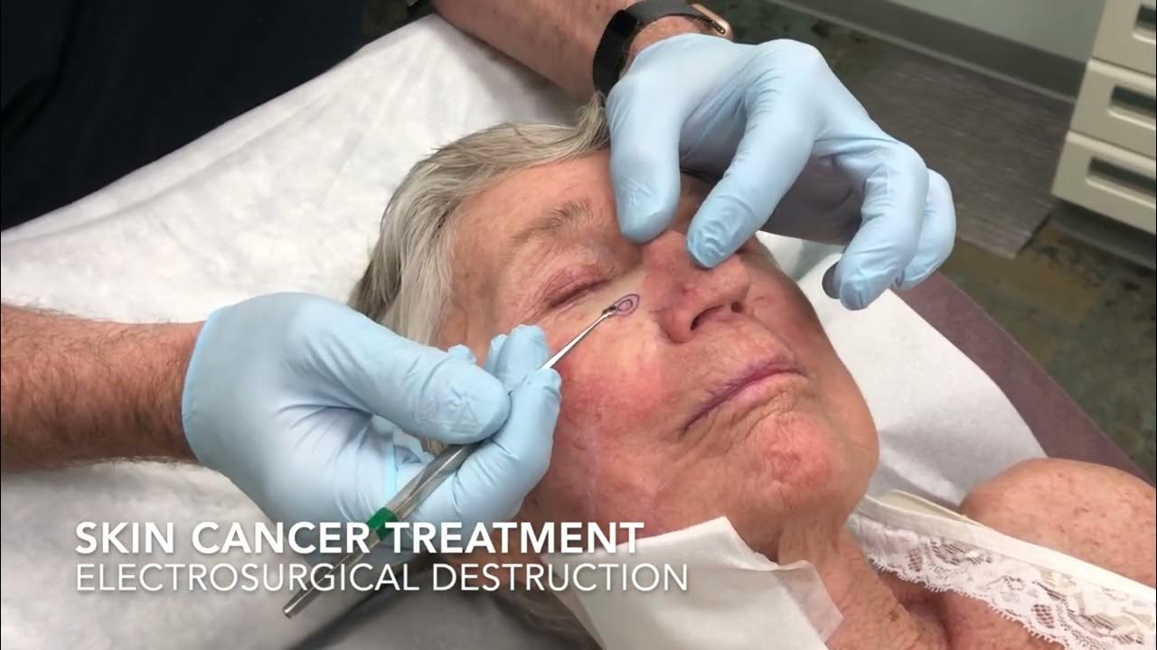 Electrosurgical Destruction of Basal Cell Carcinoma YouTube