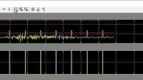 Realtime ECG processing in SIMULINK