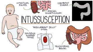 Understanding Intussusception screenshot 4