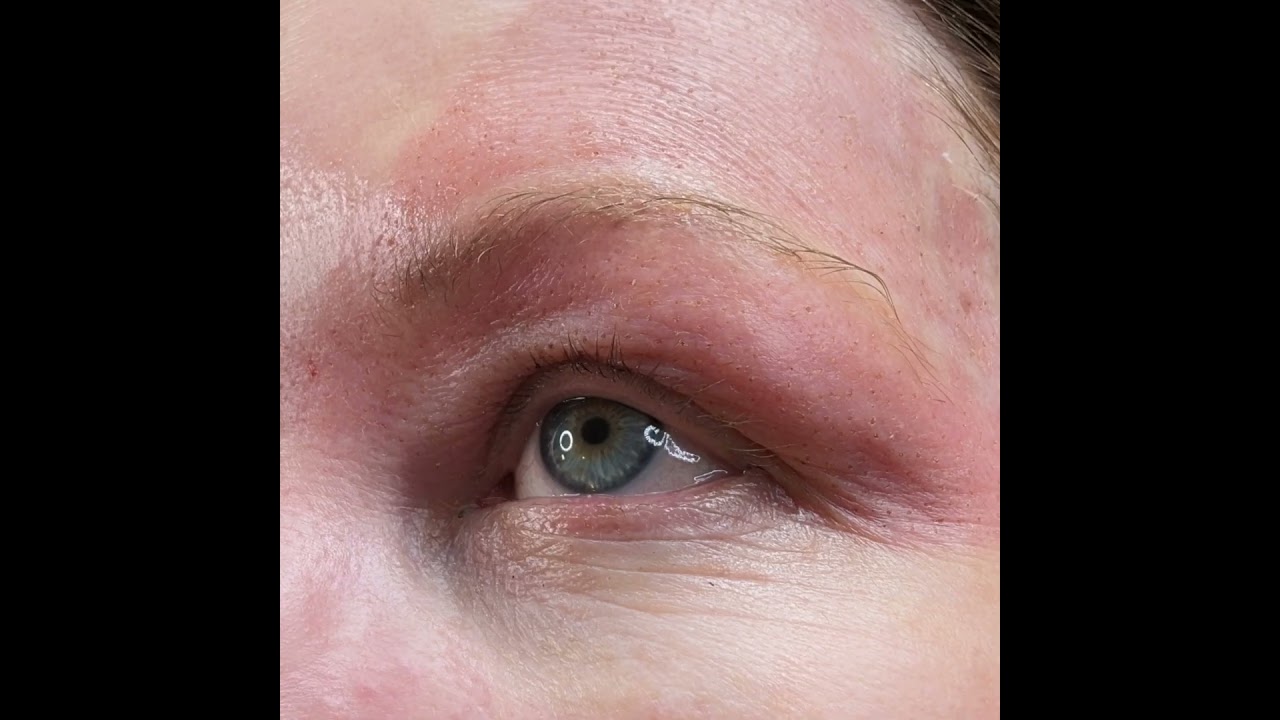 Plasma fibroblast therapy is a nonsurgical treatment commonly used for upper eye sagging