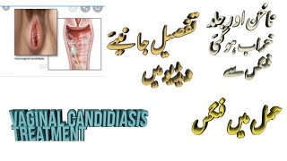 Fongone capsule uses in Urdu