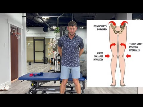 How to fix knock knees