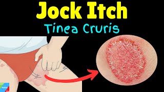 Jock Itch (Tinea Cruris): Symptoms, Causes, Diagnosis, Treatment | Ringworm of the Groin
