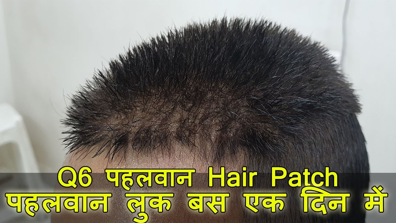 Q6 Hair Patch Price in Delhi | Q6 Hair System | Q6 Hair Patch in Bangalore  by PHC 9899746489 - YouTube