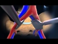 ALIF (Anterior Lumbar Interbody Fusion) -- Larry Parker M.D.