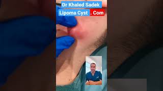 infected cyst #shorts #cystremoval #skincare #pimplepopper Dr Khaled Sadek Lipomacyst.com