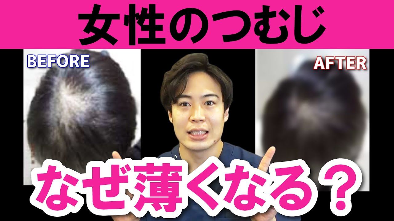 つむじハゲ 女性のつむじはなぜぼんやりと薄くなるの ハゲる原因と対策について Youtube