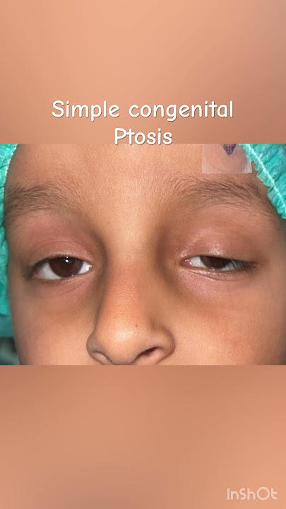 #ophthalmology #eyes #ptosis