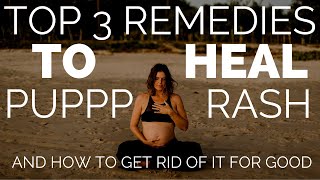 PUPPP Pregnancy Rash Natural Remedies - What Actually Works?