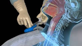 Open Suctioning with a Tracheostomy Tube - 3D animation screenshot 3
