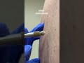 Shorts how dermatologists remove skin growths with liquid nitrogen