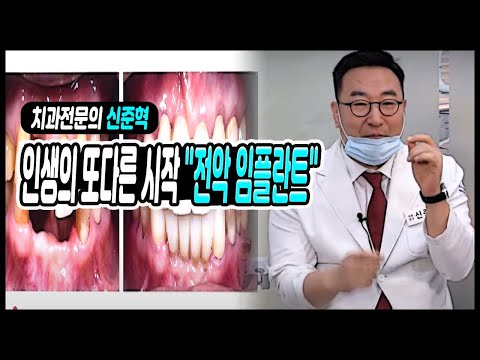 임플란트 가격