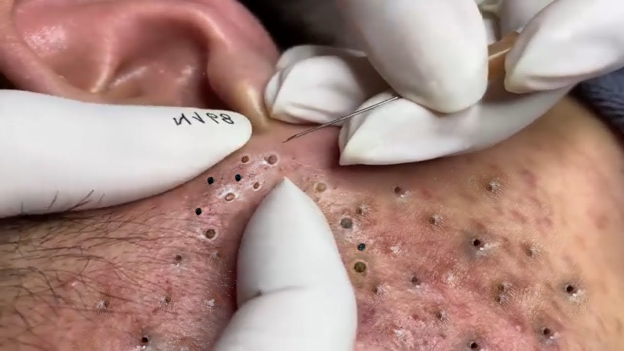 Remove Blackheads and Hidden Acne At Loan Nguyen Spa #83 - YouTube