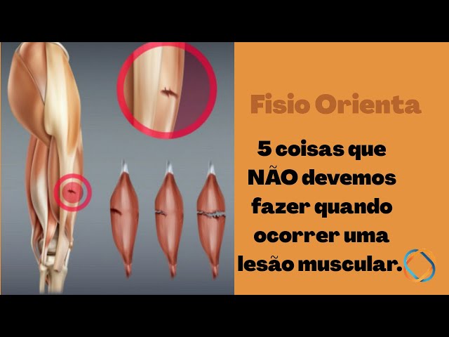 Distensão Muscular - Dr. João Hollanda