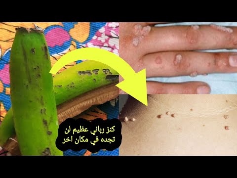 اقسم بالله انني مسحت بها الثالول و رميتها بعيدا و تخلصت من الثآليل نهائيا بدون عوده انشرها ولك الاجر