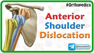 Anterior shoulder dislocation Animation : Orthopedics Lecture / USMLE Step 1