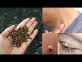 Magic ingredients  remove skin tag with in 10 minutes  mr maker