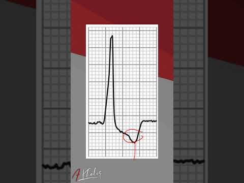 Mastering ECG Interpretation Wolff Parkinson White Syndrome Type B Explained For Medical Students